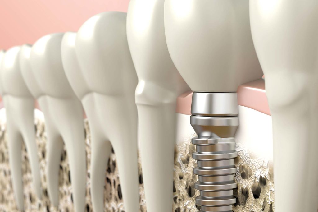 Bone grafting Dental Care Solutions