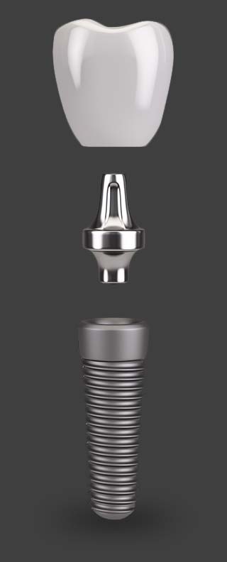 Dental Implant Model - Dental Care Solutions