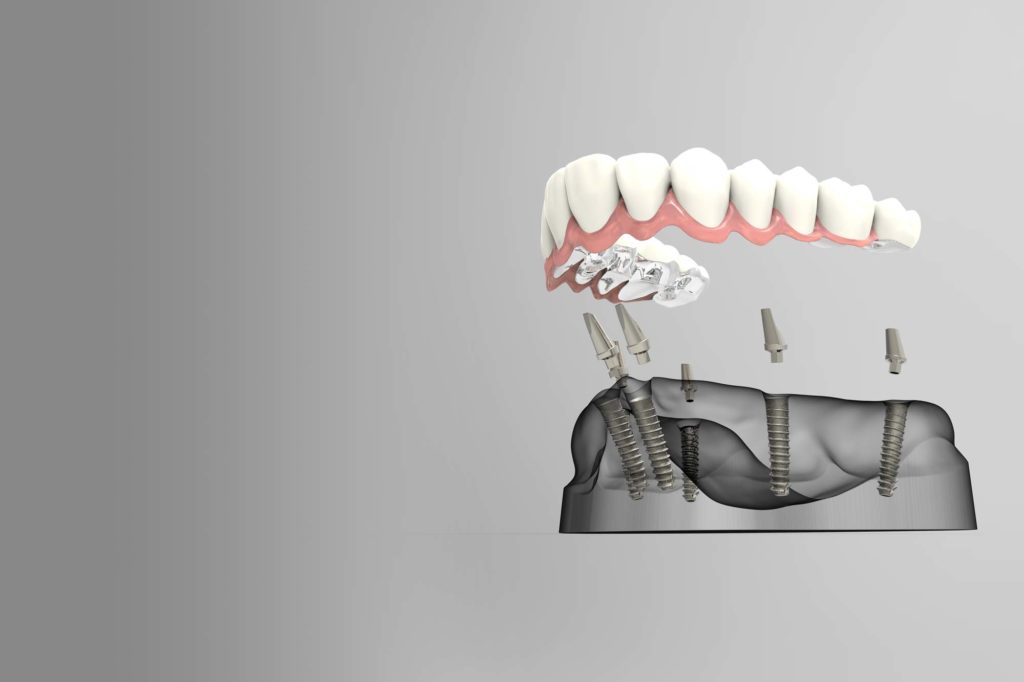 Full arch dental implant Dental Care Solutions