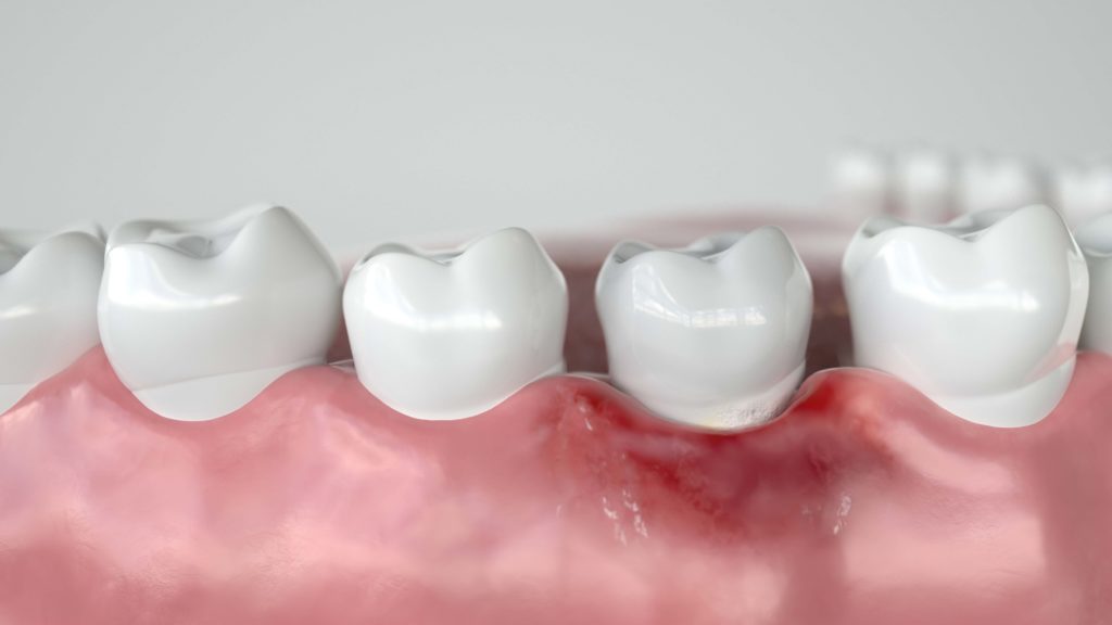 Gums needing laser dentistry Dental Care Solutions