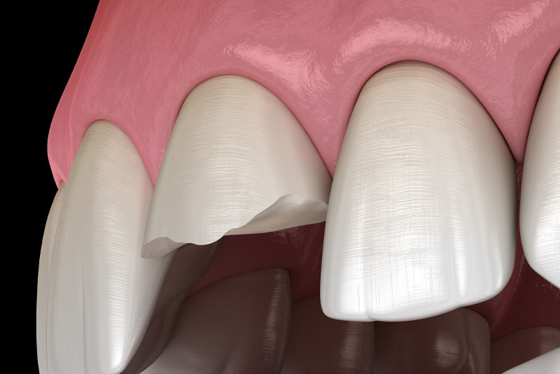 Chipped Tooth Graphic