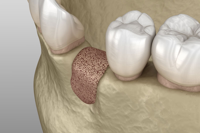 a 3d image of a bone graft securing to a jawbone.