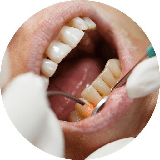 Dental Patient Undergoing Gum Disease Treatment In Bradenton
