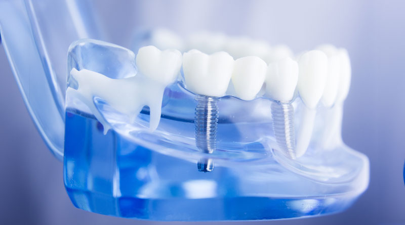 The image shows a dental implant model with a transparent blue lower jaw and white teeth