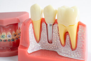 Dental implant