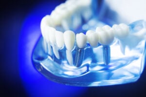 Dental teeth orthodontic dentistry teaching model with gums