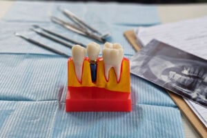 Dental implant