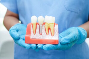 Doctor hold dental implant