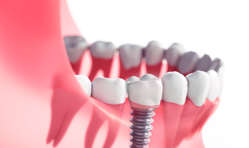 Close-up of a dental implant integrated into the lower jaw