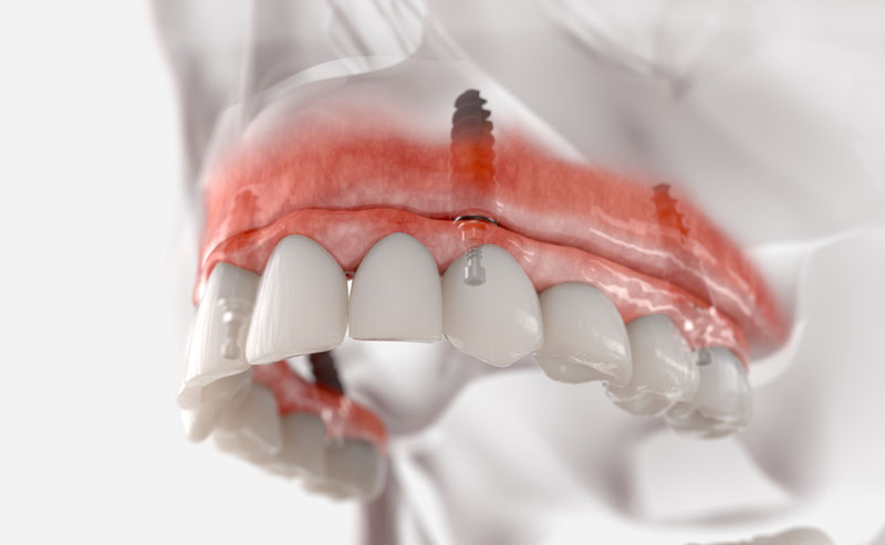 3D illustration of a maxillary fixed restoration with four dental implants