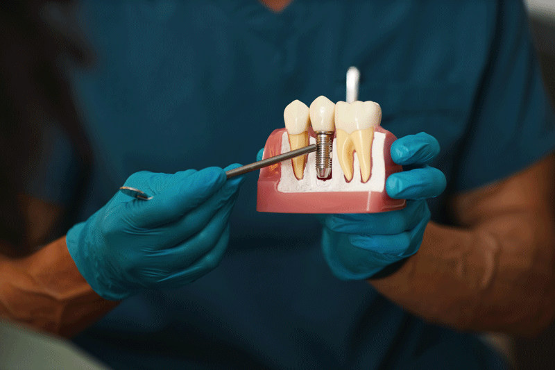 Dentist holding dental implant