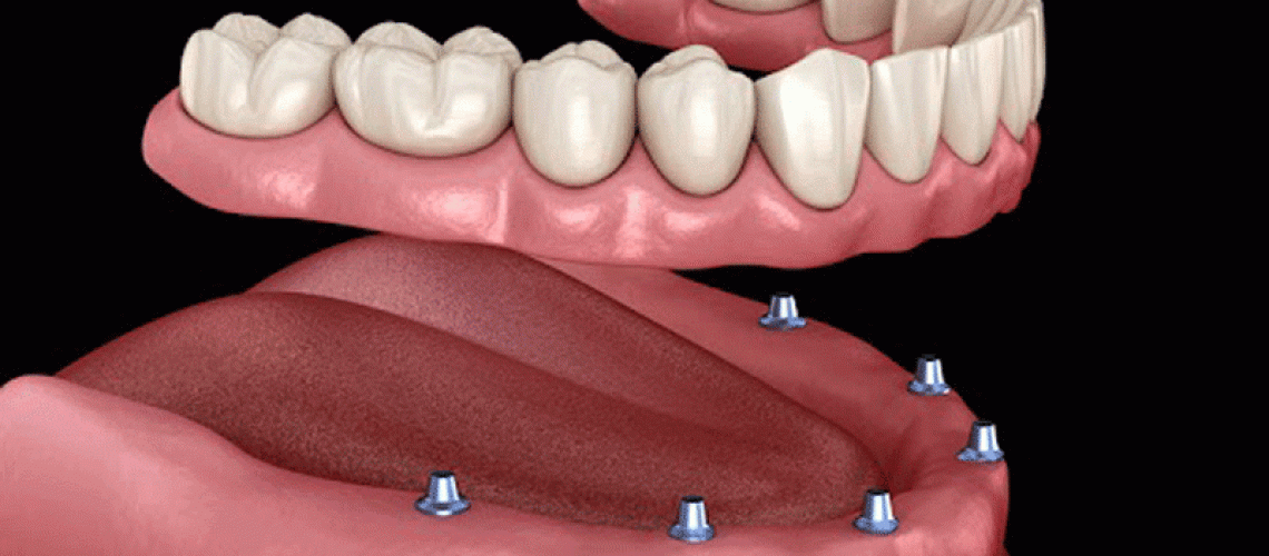 an image of a 3D dental implant model.