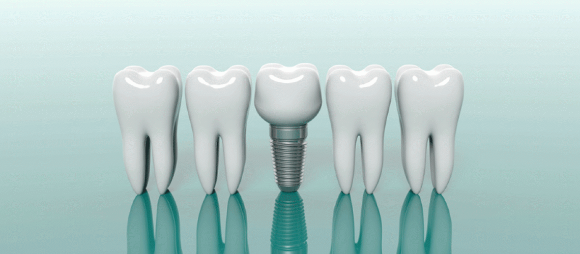 3d model of 4 teeth with a dental implant in the middle of them