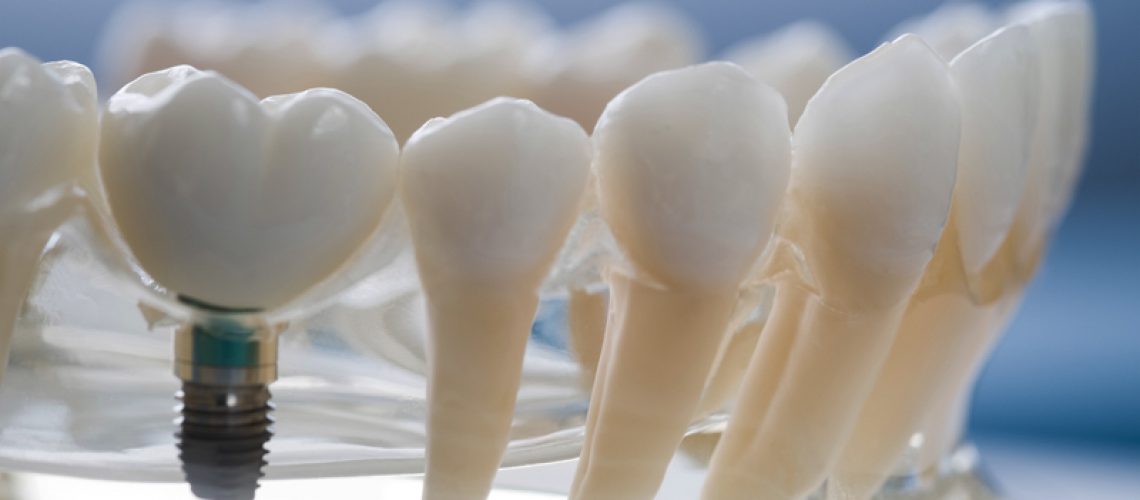 Image of a prosthesis jaw with a implant